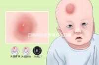 白癜風(fēng)的發(fā)病原因（白癜風(fēng)有自愈的嗎）