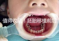 值得收藏！胚胎移植前后這些注意事項都應該知道