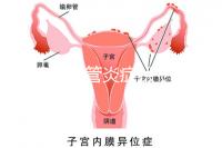 反流性食管炎癥狀（反流性食管炎癥狀有哪些反應）