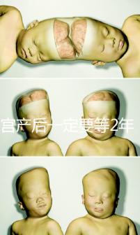 剖宮產后一定要等2年，才能試管嬰兒懷孕嗎？