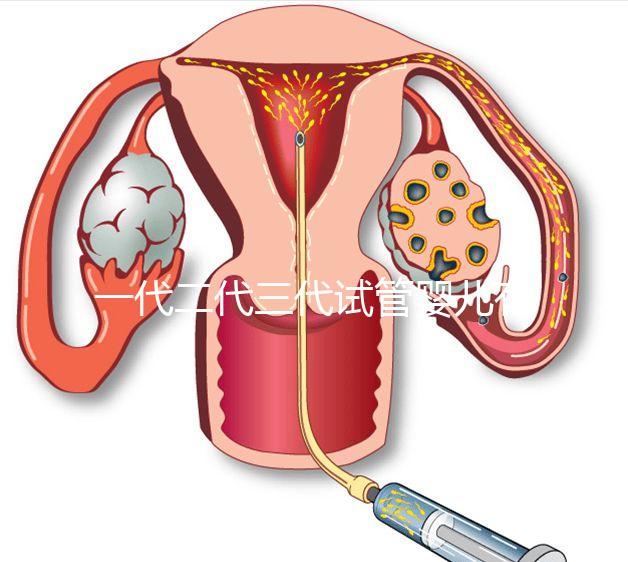 一代二代三代試管嬰兒有什么區別？