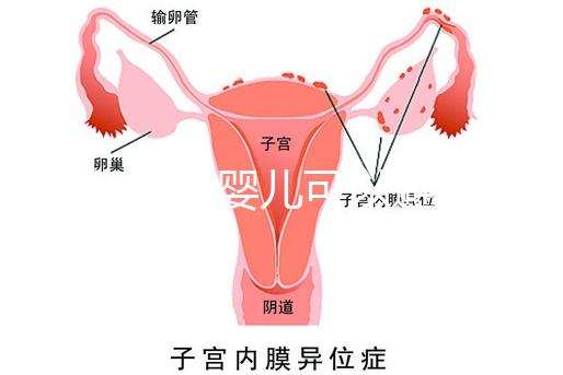 三代試管嬰兒可以避免重癥聯合免疫缺陷病遺傳嗎