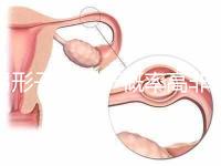 弓形子宮流產(chǎn)概率高非個(gè)例！罪魁禍?zhǔn)资沁@個(gè)原因