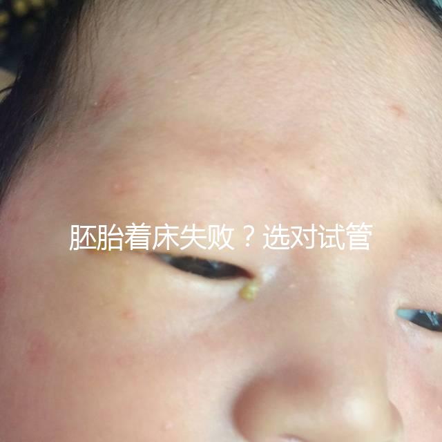 胚胎著床失?。窟x對試管嬰兒醫生很重要