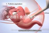 食道癌（食道瘤是怎樣引起的）