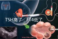 TSH高了，F(xiàn)T4低了，需要補(bǔ)碘嗎？